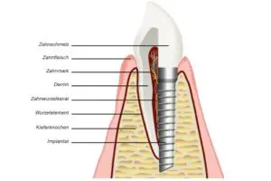 Zahnimplantat Aufbau