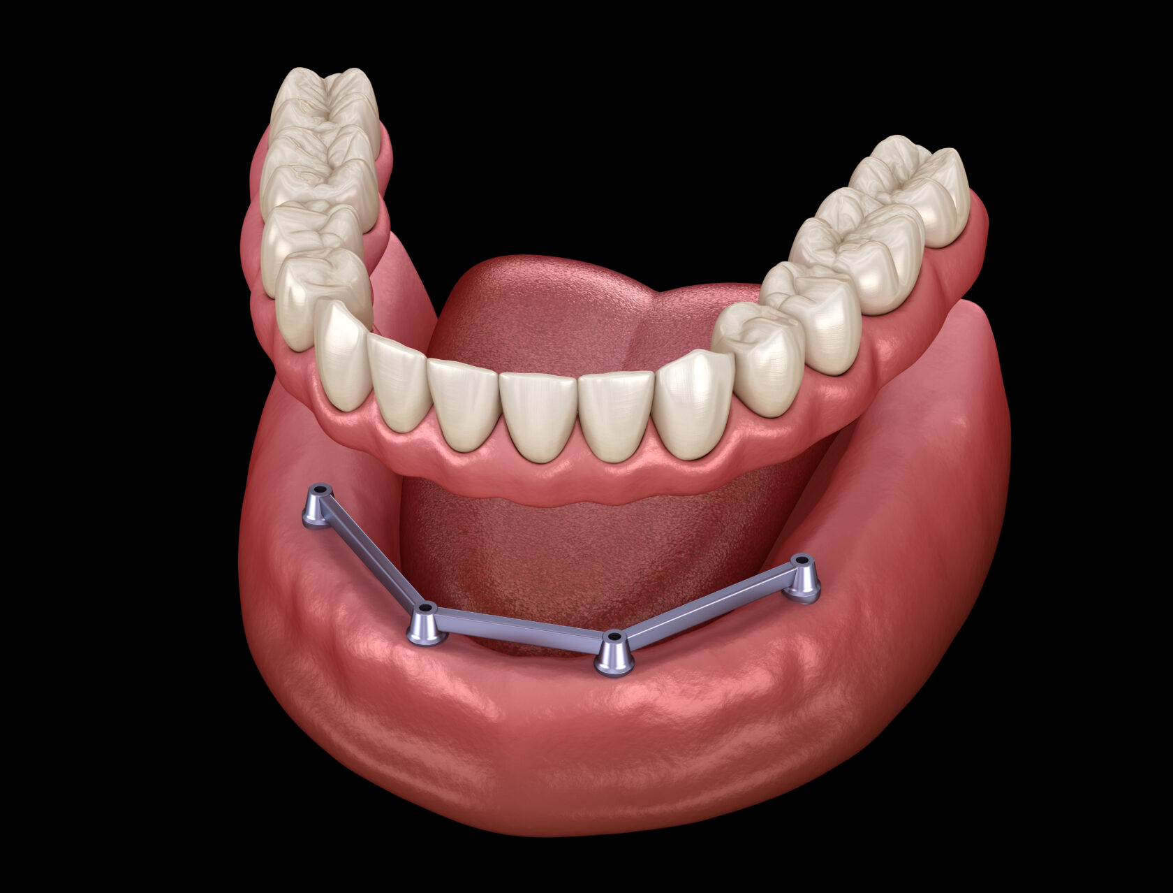 Zahnersatz Vorteile Und Nachteile - Vollprothese, Implantate & Co.